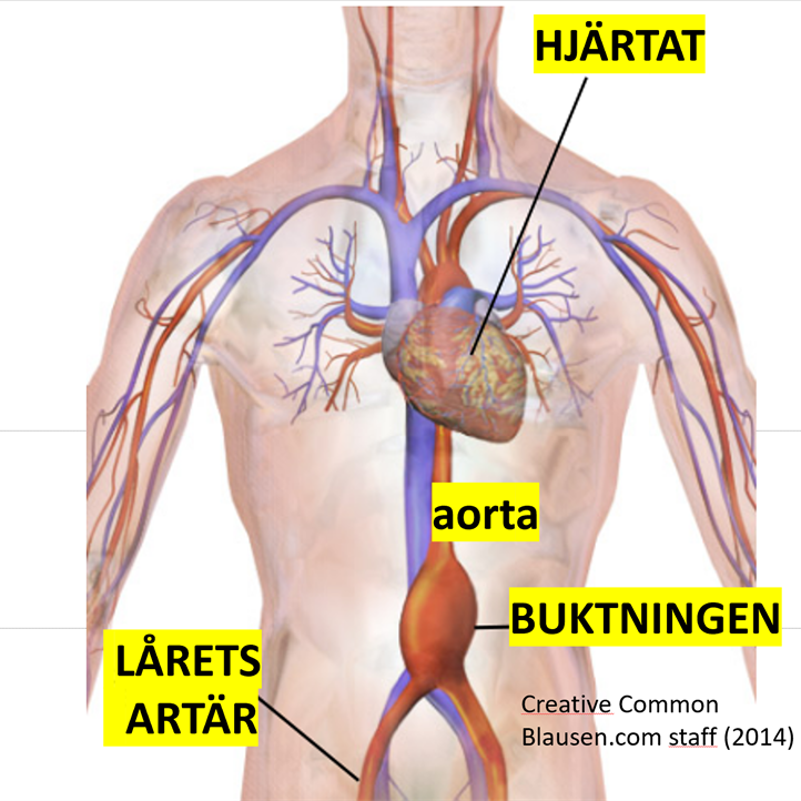 aortaaneurysm